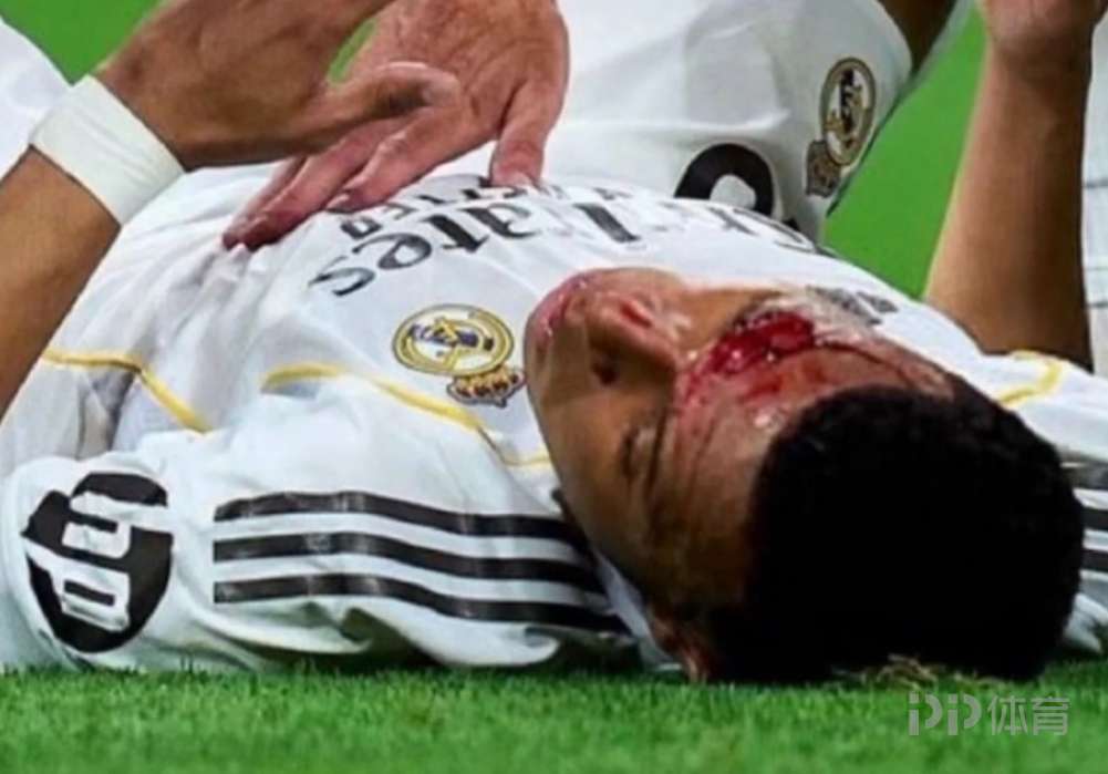 皇馬官方：姆巴佩眉骨縫針 缺席球隊(duì)今日合練